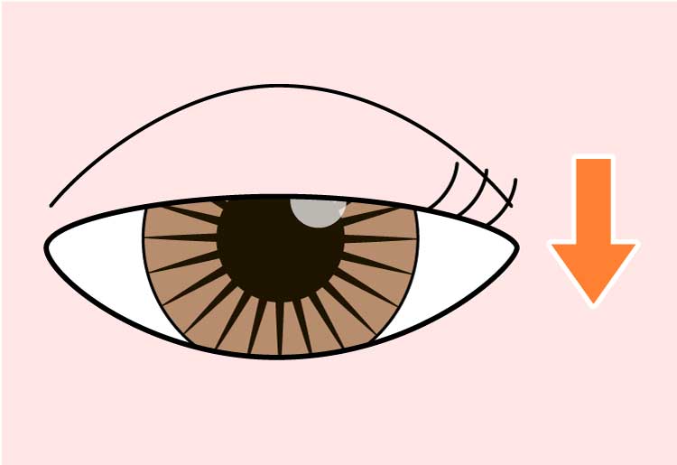 眼瞼下垂の状態