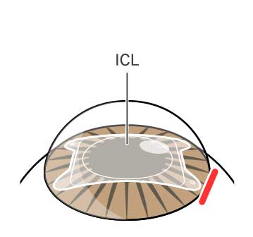 ICL手術方法
