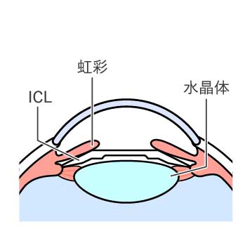 ICL手術方法